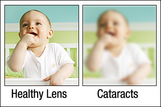 healthy-lens-cataractsjpg